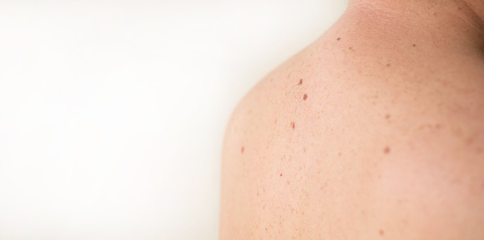 Cİlt Kanserlerİ ve Cerrahİsİ